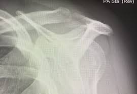 These patients had type ii (curved) acromion, according to bigliani classification. Epos Trade