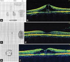 Resurrection Of The Amsler Chart In Macular Diseases Nassar