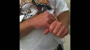 Surgery may be necessary in cases of joint dislocation or associated fractures. Setting A Dislocated Pinky Youtube