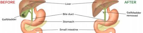 Pundi hempedu anda boleh membengkak dan membentuk batu karang. Diet Selepas Buang Hempedu Fit Mummy For Life