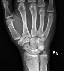 Image result for Hamate Bone