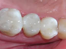 Dental Fillings 101 Answers To Your Top Questions About Getting Cavities Filled Downtown Toronto Dentist Toronto Dentistry Soho Dental
