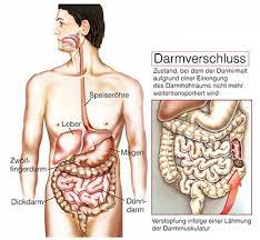 Je nach ursache unterscheiden mediziner dabei zwischen einem. Darmverschluss Ileus Ursachen Symptome Behandlung Medlexi De