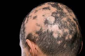 Be one step ahead of hair loss. Technique For Minimizing Chemotherapy Induced Alopecia Gaining A Foothold In The States Oncology Nurse Advisor