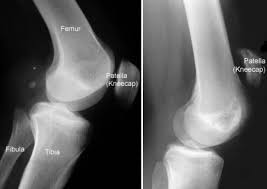 It usually requires surgery and physical therapy to. Patellar Tendon Tear Orthoinfo Aaos