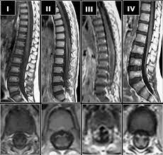Reflexe fehlen oder sind abgeschwächt. Four Different Mr Imaging Patterns According To Their Contrast Download Scientific Diagram