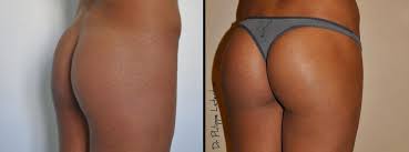 Le prix augmentation fesses tunisie est moins cher qu'en france et coûte 2950 € pour un séjour de 5 nuitées. Chirurgie Esthetique Des Fesses Par Protheses A Nice 06