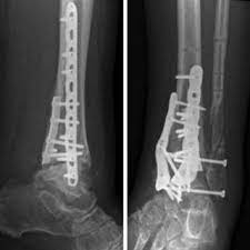 Osteoarthritis can be caused by aging, heredity, and injury from trauma or disease.; Abb 4 9 Schwere Posttraumatische Arthrose In Fehlstellung Abgeheilt Download Scientific Diagram