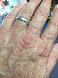 Pest Alert English Ivy Rash North Carolina Cooperative Extension