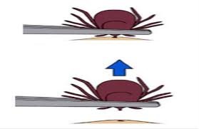 Image result for Tick Removal