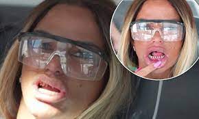 Katie price proudly showed off her new veneers (credit: Katie Price Shows Off Her Metal Teeth As She Gets Veneers Fitted Daily Mail Online