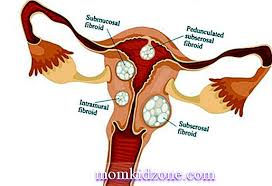 Menghilangkan fibroid/kulit berlebih di tubuh. Fibroid Rahim Sebab Tanda Rawatan Kehamilan 2021