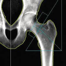 Bone density scan DEXA