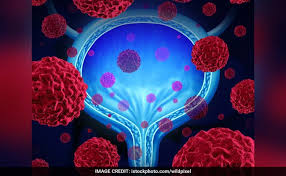 What are prostate cancer symptoms? Infertile Men Are Thrice As Likely To Develop Aggressive Prostate Cancer