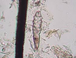 Image result for Demodex folliculorum