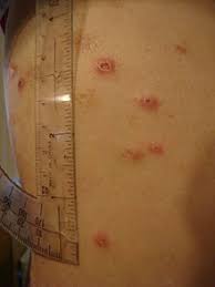 Non sono note strategie per prevenire la comparsa di una malattia autoimmune. Malattia Di Crohn Wikipedia