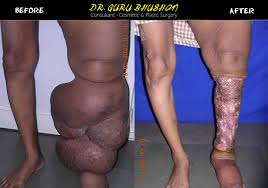 Image result for elephantiasis