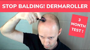 Microneedling (mn), also known as collagen induction therapy, was invented about 20 years ago by a plastic surgeon. Microneedling For Hair Loss Sign Of Balding And Tips Jj Ellie Skincare