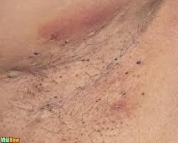 What are ingrown hairs and how do you get rid of them?getty images. Get Rid Of Blackheads On Your Underarms With A Geranium Essential Oil Vs A Baking Soda And Eucalyptus Scrub Vs An Olive Oil Coconut Sugar And Yogurt Scrub And 5 More Visihow