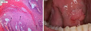 Image result for papillomavirus tongue)