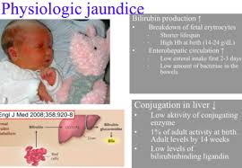 Gulsott (ikterus) hos nyfødte refererer seg til gulfargingen av hud og det hvite på øynene (sklera) hos nyfødte barn. Sykdommer Hos Nyfodte Flashcards Quizlet