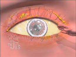 Cholesterol Deposits In The Eye The Doctors Youtube