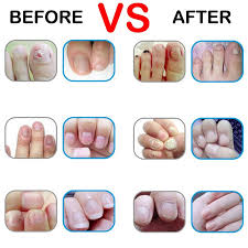 Bioclear Nail Fungus Pen Reviews Bioclear Nail Fungus Repair Pen 50 Off Today