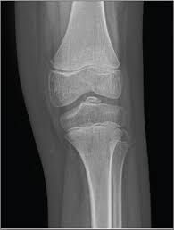 Image result for Ballottable Patella Sign