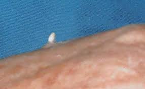 Image result for cornu cutaneum)