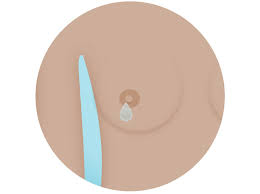 Often the first symptoms women notice is a lump or area of thickened tissue in breast or underarm. Breast Cancer Symptoms And Signs National Breast Cancer Foundation