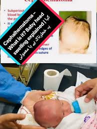 Image result for Cephalhematoma