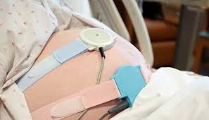 External fetal heart rate and contraction monitors on a pregnant abdomen