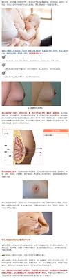 乳头内陷的危害与治疗健康科普-首都医科大学附属北京潞河医院
