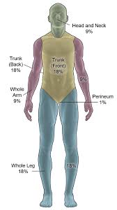 icd 10 continues to follow rule of nines but allows wiggle