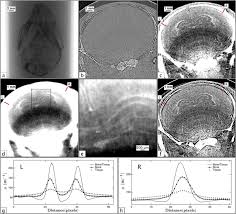In Situ Phase Contrast X Ray Brain Ct Scientific Reports