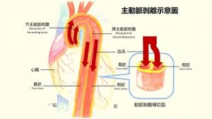 比起因為馬凡氏症導致的主動脈剝離， 因為高血壓或其他因素的病例是馬凡的上百倍吧。 最後想說的是真的被診斷有馬凡也不用太擔心， 因為馬凡氏症的表徵其實很多元， 從真的最嚴重的重症到一生完全無症狀都有。 è¡›æ•™ ä¸»å‹•è„ˆå‰é›¢ é¦¬å‡¡ä¹‹å®¶
