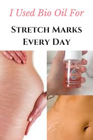 Bio Oil White Stretch Marks Before And After I Used Bio Oil For Stretch Marks Every Day Here Is What You Should Know Acneremedieshomemade Beau In 2020 Oil For Stretch Marks Bio Oil Stretch Marks Stretch Marks