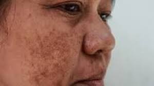 Pigmentation Treatment: Effective Solutions for Clear Skin