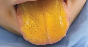 Image result for yellow tongue infection