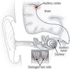 Check spelling or type a new query. Tinnitus Ringing In The Ears And What To Do About It Harvard Health