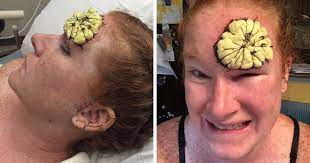 Larger cancers may even have … Mom Shares Her Before After Skin Cancer Photos Bored Panda