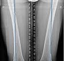 Osteotomy and Plate Insertion for Bilateral Knee Valgus