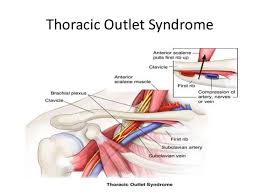 What Is Thoracic Outlet Syndrome And How To Fix It Touch Of Life Physical Therapy