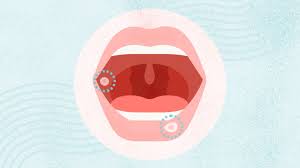 Image result for Mouth ulcers roof of mouth