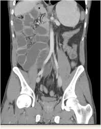 Image result for Intestinal Malrotation