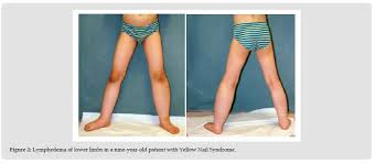 Image result for Yellow nail syndrome feet