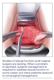 Assessing And Treating Sexual Function After Vaginal Surgery Mdedge Obgyn