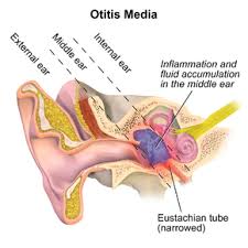 Clinical features are recurrent otorrhoea through a tympanic perforation, with conductive hearing loss of varying severity. Otitis Media Wikipedia