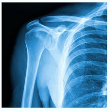 Image result for Shoulder XRay