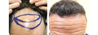 Donato zizi impegnato nella chirurgia della calvizie dal 1999, è stato uno dei primi medici in . Tricogenesis Autotrapianto Tecnica Fue Trapianto Capelli Calvizie Clinica Firenze
